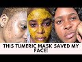 THE TUMERIC MASK THAT CLEARED MY ACNE SCARS AND HYPER PIGMENTATION!