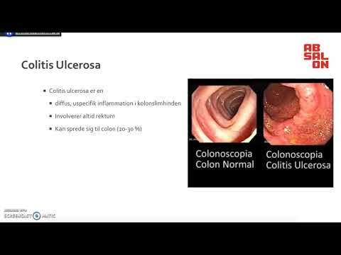 Video: Crohns Sygdom Vs. Ulcerøs Colitis Vs Inflammatorisk Tarmsygdom