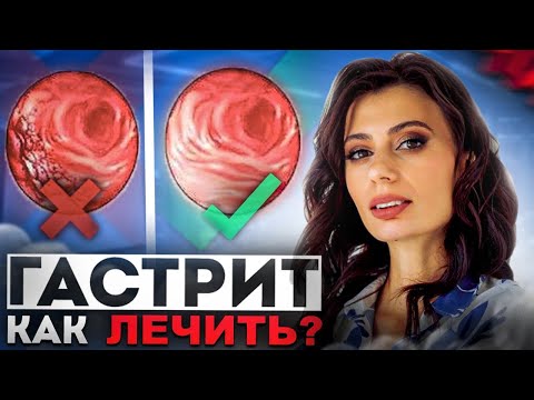 КАК ЛЕЧИТЬ ГАСТРИТ? Причины развития гастрита и питание, которое Вас спасёт