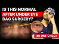 Under Eye Bags Removal Recovery | Real Blepharoplasty Healing Timeline! | Dr DC, Plastic Surgeon
