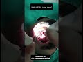 SALIVARY GLAND STONE