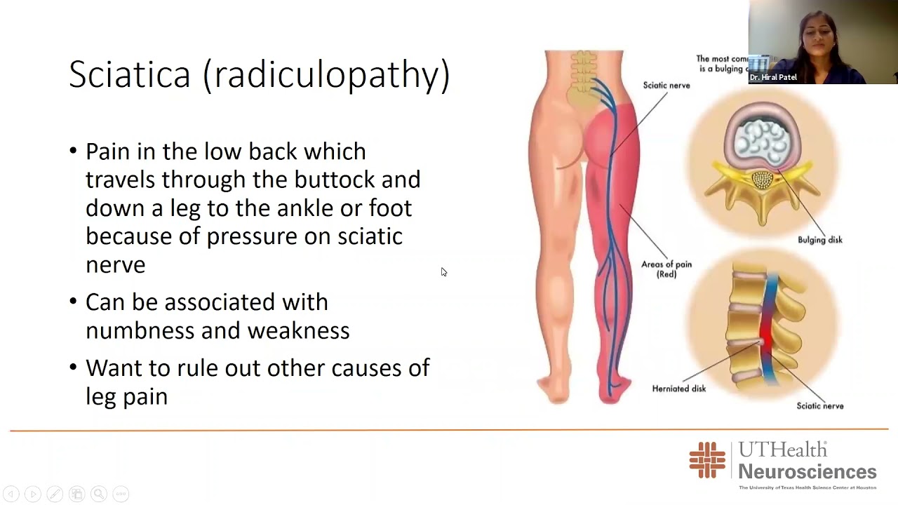 What Causes Sciatica and Buttock Pain? – Neuragenex