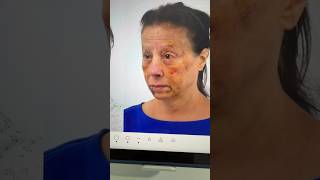 One week after lower Blepharoplasty, fat transfer and deep chemical peel