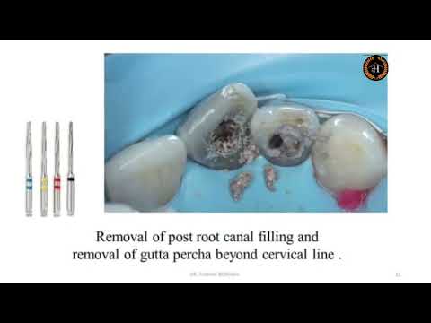 INTRACORONAL BLEACHING