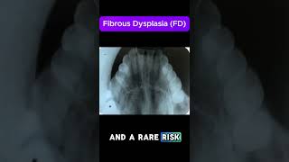 Fibrous Dysplasia FD