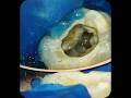 RCt of 16,Mb1 and mb2 with spoe,#mb2 #endo #rootcanal #rct