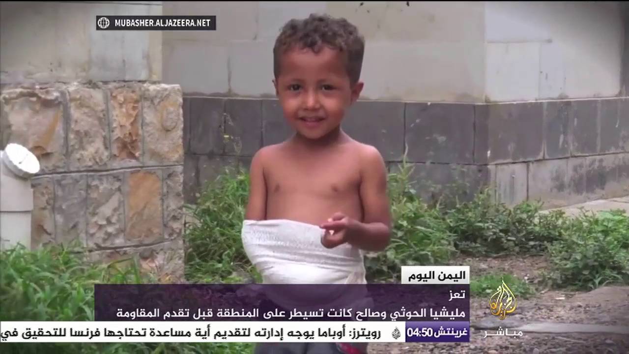 سألناه ماذا حدث ليدك.. فأجاب بطفولة وابتسامة: "قنبلة"!