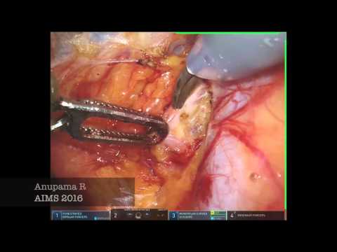 Sentinel Node Mapping - Endometrial cancer- Robotic Platform