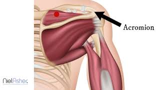 Supraspinatus - How To Find Trigger Points (Shoulder Pain) The Shoulder Pain Trigger Points