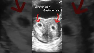 '6 Weeks Pregnant with Bicornuate Uterus: Ultrasound Scan'