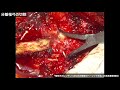 動画6　腰椎分離すべり症に対する腰椎後方椎体固定術：分離椎弓の切除