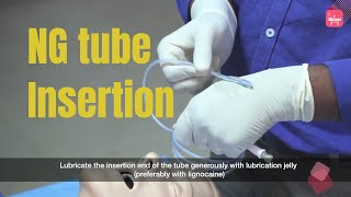 #Ryles Tube Insertion #procedure: step by step