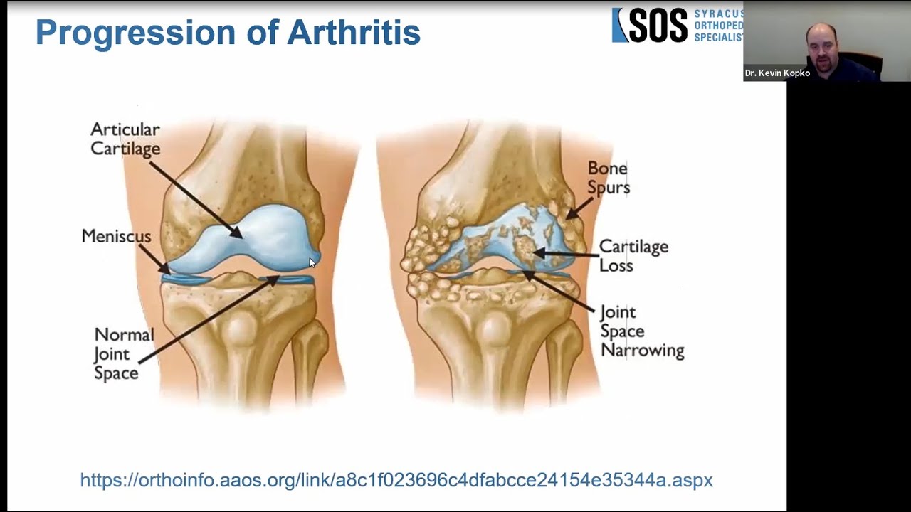 Arthritis: An Overview - OrthoInfo - AAOS