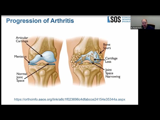 Arthritis: An Overview - OrthoInfo - AAOS