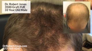 Dr. Robert Jones - 3500 Graft FUE - 33 Year Old Male