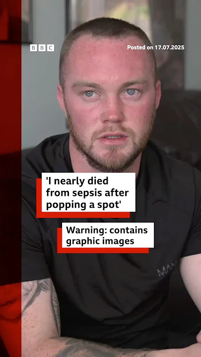 Popping a pimple led to a man getting sepsis. #BBCNews