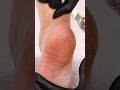 Ultimate feet treatment for cracked heels💯