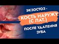 Экзостоз. Торчит кость после удаления.