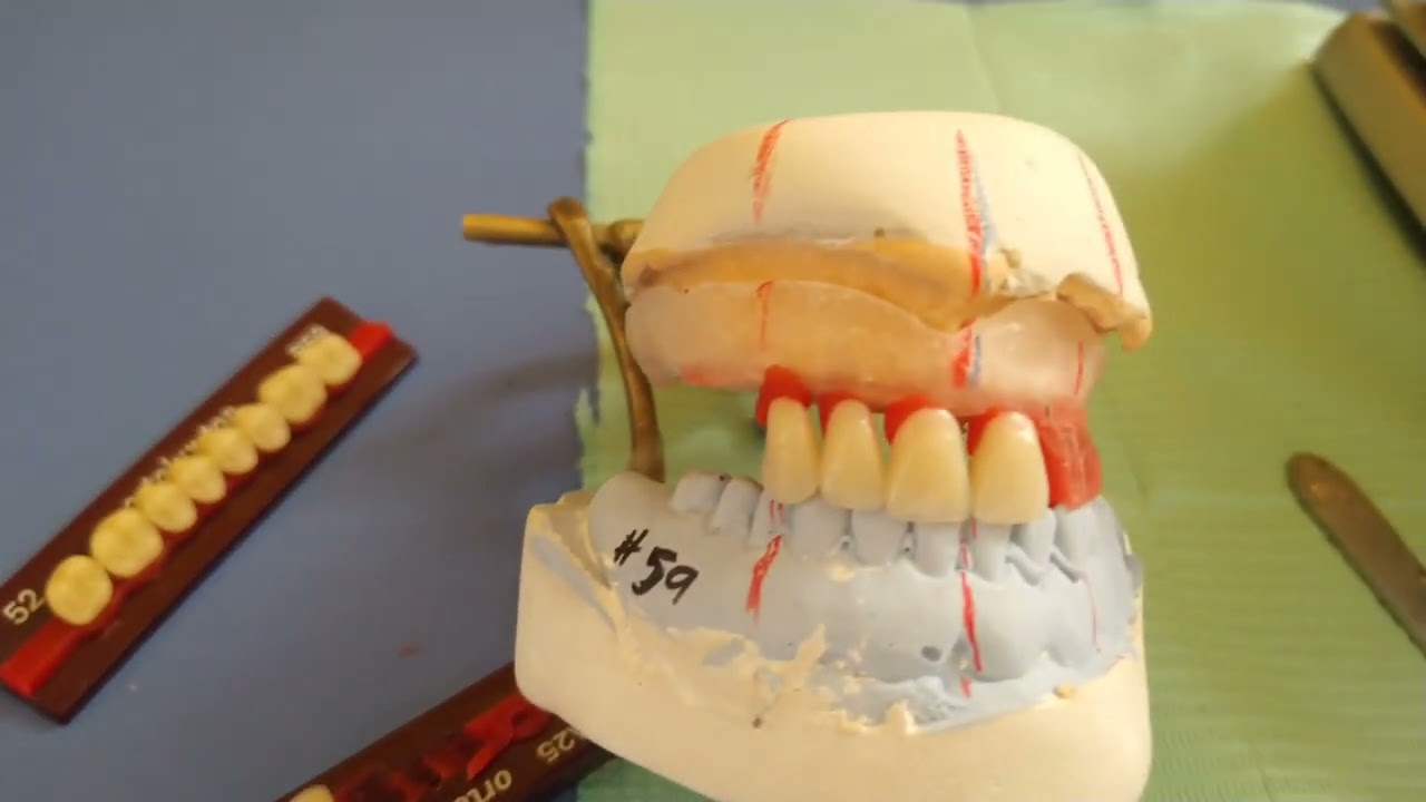 DETALLES EN UN ENFILADO DE DINTES. 🦷❤️EN UNA PRÓTESIS 😉👍