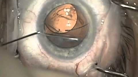 Intraocular lens repositioning with anterior vitrectomy, cortical cleanup and IOL capture