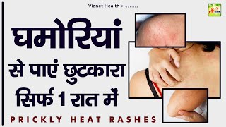 घमोरियां से पायें छुटकारा सिर्फ़ 1 रात में । घमौरी का घरेलू उपचार |  @ViaNet Health