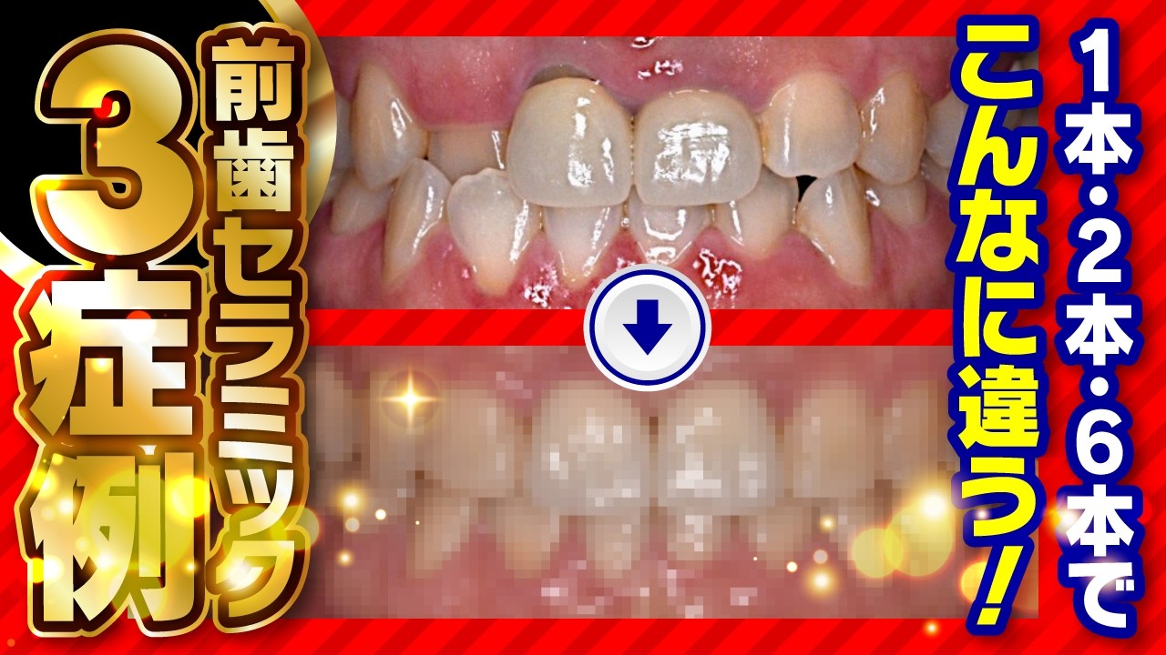 Case study] How ceramic front teeth can make such a difference