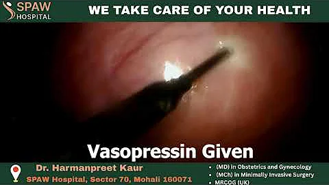 Large Fibroid Removal (24 Weeks Size) with Advanced Surgical Technique | SPAW Hospital