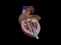 Аортальный стеноз: лечение эндоваскулярным методом трансапикальным доступом