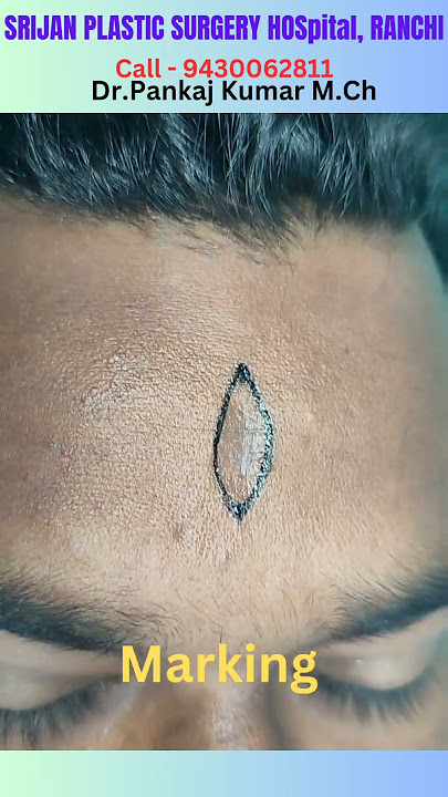scar revision surgery in Ranchi| Scar treatment| #shorts # youtubeshorts