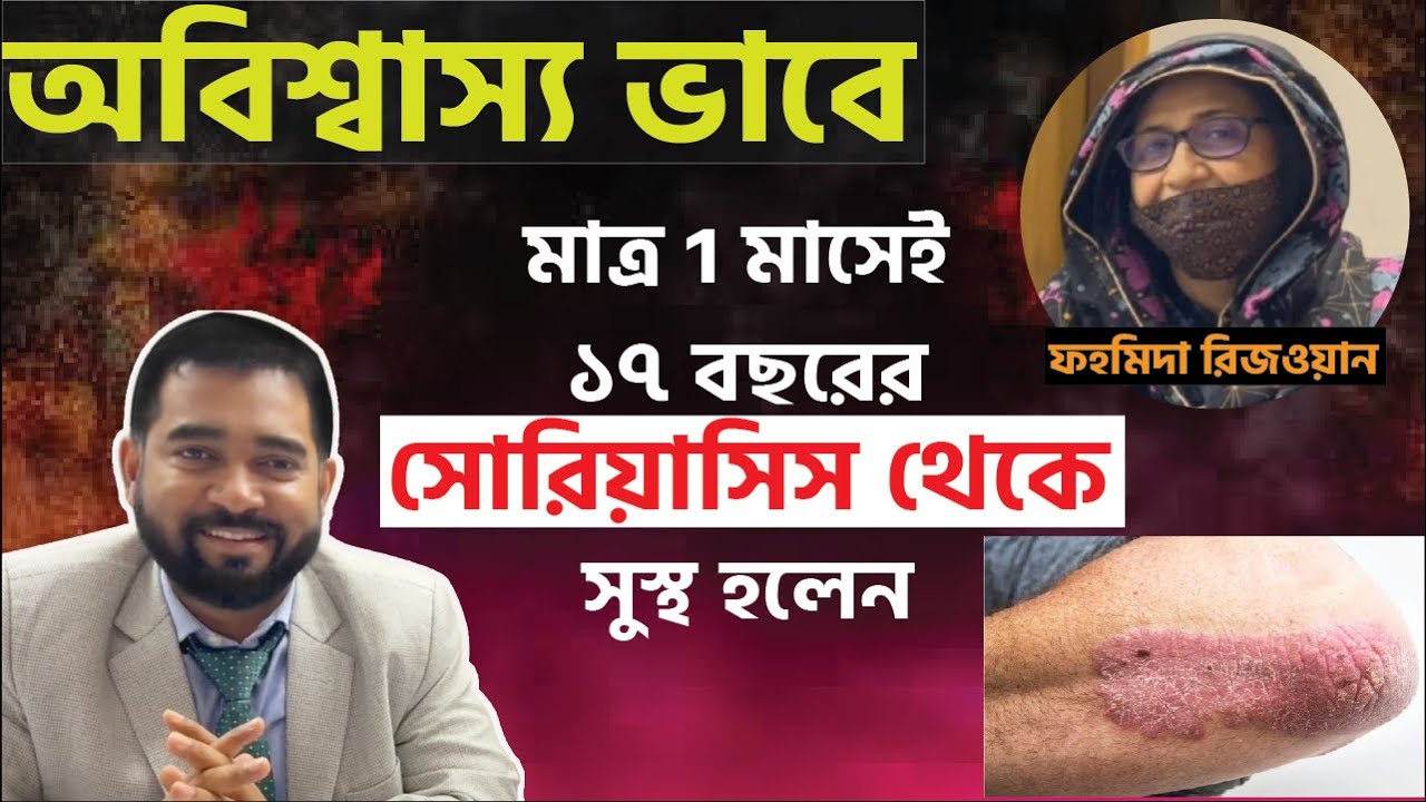 ফহমিদা রিজওয়ান ১৭ বছরের সোরিয়াসিস থেকে সুস্থ হয়ে নিজের অনুভূতি শেয়ার করলেন। ACRH | Dr Haque