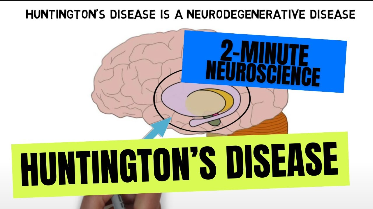 huntington's disease brain areas affected