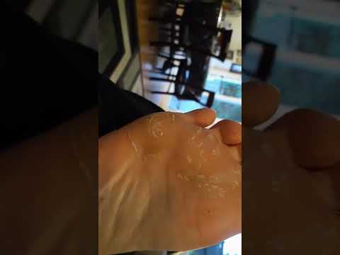 peeling off skin after chemical foot peel