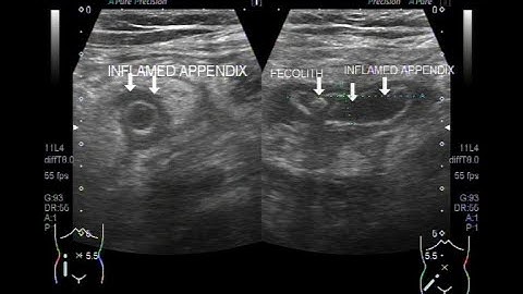 Acute Appendicitis with Fecalith in its interior.