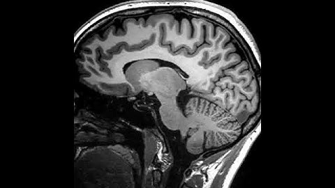 MRI of Brain