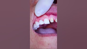 Răng sứ thẩm mỹ - Bí quyết cho nụ cười tự tin, tỏa sáng mỗi ngày #rangsuthammy #shorts #dentist