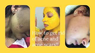 How to get rid of acne and acne scars from our face - Sosi Habeshawit