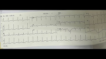 Thiếu máu cơ tim (ischemia)