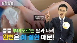 [KNN건강튜브] 내 몸속의 노폐물 처리장, 림프에 부종이 생긴다면?🤔