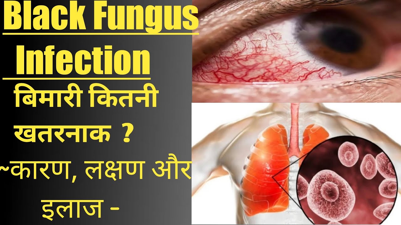 Black Fungus Disease Hindi//Black Fungus Inection Kya Hota Hai //Black