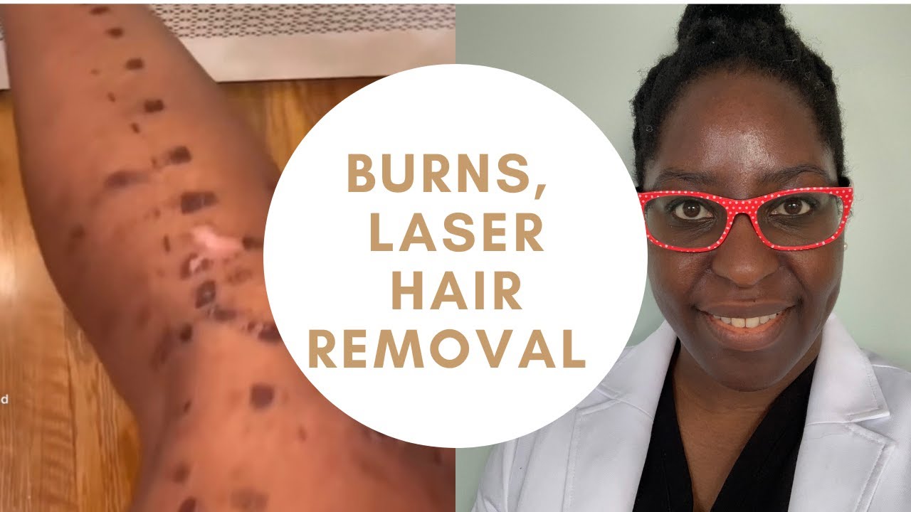Burns, Laser Hair Removal, Laser hair removal for dark skin - YouTube