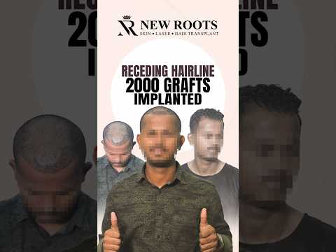 Receding Hairline Transplant in Mumbai | 2000 Grafts Implanted #hairtransplant #mumbai #shorts