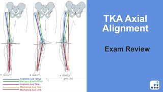 TKA Axial Alignment Exam Review - Douglas Dennis