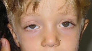 Oculoplastica | Ptosi palpebrale congenita pediatrica