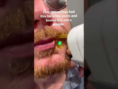 Cherry angioma removal