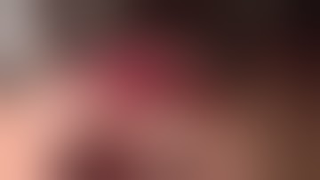 Lateral Ridge Augmentation #9 Site, using Mineross & Memlok, Bone Fill & Suturing