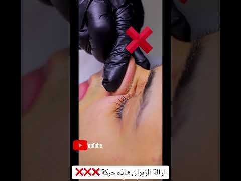 زيوان الأنف طريقة القضاء على الدهون الزيوان الرؤوس السوداء   