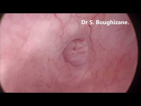 Video: Adenomyosis - Sebab Dan Gejala Adenomyosis Dan Pencegahannya