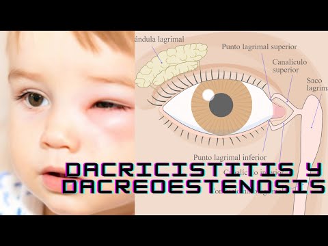 Dacriocistitis y Dacroestenosis congenita