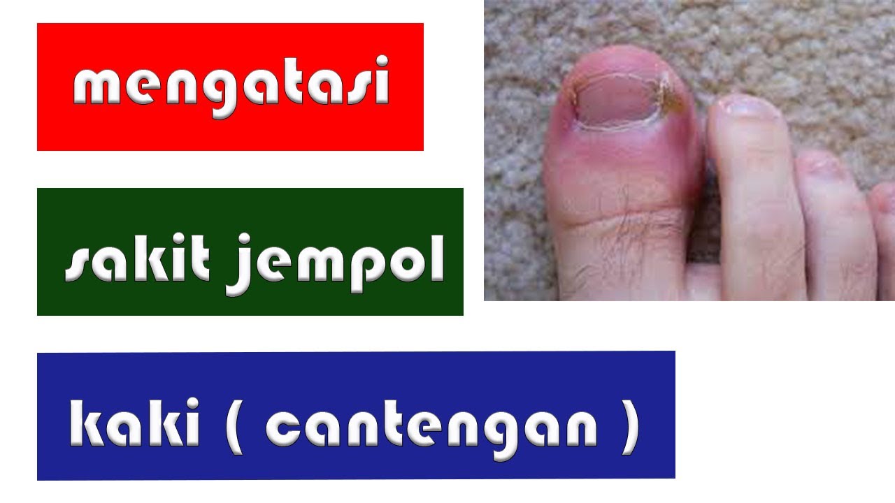 CARA MENGATASI SAKIT JEMPOL KAKI || CANTENGAN