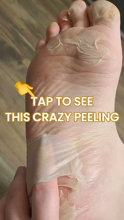 Crazy Peeling Results after Using the Plantifique Foot Peel Mask | Safe Dermatologist Tested Formula